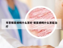 寻常银屑病喝什么茶好 银屑病喝什么茶能治疗
