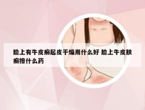 脸上有牛皮癣起皮干燥用什么好 脸上牛皮肤癣擦什么药