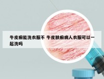 牛皮癣能洗衣服不 牛皮肤癣病人衣服可以一起洗吗