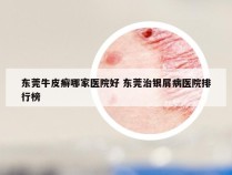东莞牛皮癣哪家医院好 东莞治银屑病医院排行榜