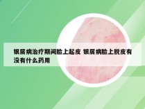 银屑病治疗期间脸上起皮 银屑病脸上脱皮有没有什么药用