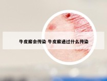 牛皮廨会传染 牛皮廨通过什么传染