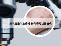 脚气膏治牛皮癣吗 脚气膏可以治癣吗