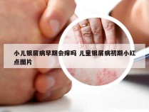小儿银屑病早期会痒吗 儿童银屑病初期小红点图片