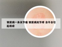 银屑病一身关节痛 银屑病关节疼 会不会引起癌症