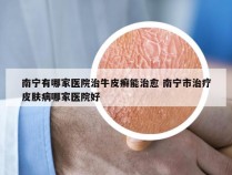 南宁有哪家医院治牛皮癣能治愈 南宁市治疗皮肤病哪家医院好