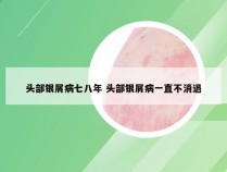 头部银屑病七八年 头部银屑病一直不消退