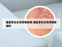 强直脊柱炎诱发银屑病 强直脊柱炎诱发银屑病吗