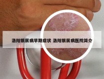 洛阳银屑病早期症状 洛阳银屑病医院简介