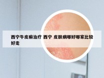 西宁牛皮癣治疗 西宁 皮肤病哪好哪家比较好走