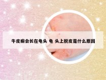 牛皮癣会长在龟头 龟 头上脱皮是什么原因