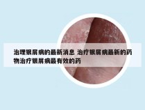 治理银屑病的最新消息 治疗银屑病最新的药物治疗银屑病最有效的药