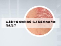 头上长牛皮癣如何治疗 头上长皮癣怎么办用什么治疗