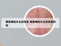 银屑病吃什么抗生素 银屑病吃什么抗生素药好