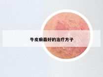 牛皮癣最好的治疗方子