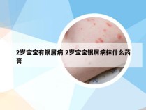 2岁宝宝有银屑病 2岁宝宝银屑病抹什么药膏