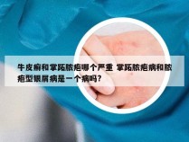 牛皮癣和掌跖脓疱哪个严重 掌跖脓疱病和脓疱型银屑病是一个病吗?