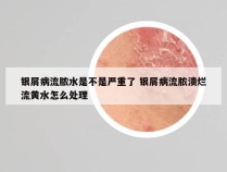 银屑病流脓水是不是严重了 银屑病流脓溃烂流黄水怎么处理