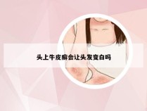 头上牛皮癣会让头发变白吗