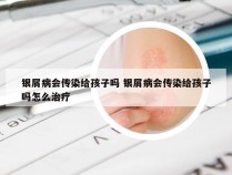 银屑病会传染给孩子吗 银屑病会传染给孩子吗怎么治疗