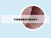 牛皮癣患者能不能吃橘子