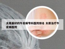 太原最好的牛皮癣专科医院排名 太原治疗牛皮癜医院
