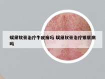 蜈黛软膏治疗牛皮癣吗 蜈黛软膏治疗银屑病吗