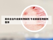 新农合治牛皮癣生物制剂 牛皮肤癣生物制剂医保
