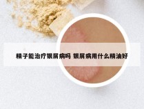 精子能治疗银屑病吗 银屑病用什么精油好