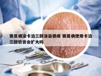 银屑病涂卡泊三醇涂染很痒 银屑病使用卡泊三醇软膏会扩大吗