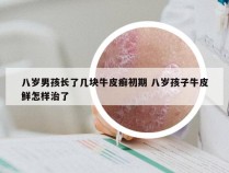 八岁男孩长了几块牛皮癣初期 八岁孩子牛皮鲜怎样治了