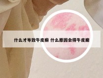 什么才导致牛皮癣 什么原因会得牛皮廨