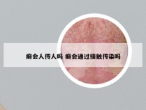 癣会人传人吗 癣会通过接触传染吗