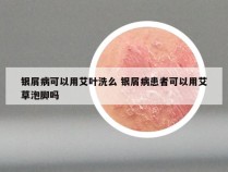 银屑病可以用艾叶洗么 银屑病患者可以用艾草泡脚吗