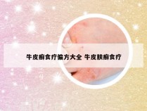 牛皮癣食疗偏方大全 牛皮肤癣食疗