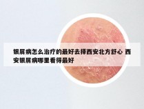 银屑病怎么治疗的最好去择西安北方舒心 西安银屑病哪里看得最好