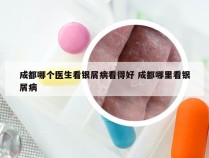 成都哪个医生看银屑病看得好 成都哪里看银屑病