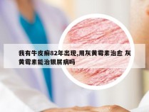 我有牛皮癣82年出现,用灰黄霉素治愈 灰黄霉素能治银屑病吗