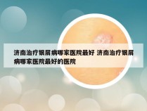 济南治疗银屑病哪家医院最好 济南治疗银屑病哪家医院最好的医院