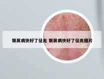 银屑病快好了征兆 银屑病快好了征兆图片