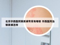 北京华西医院银屑病专家有哪些 华西医院治银屑病怎样