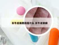 长牛皮癣原因是什么 长牛皮肤癣