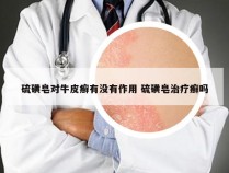 硫磺皂对牛皮癣有没有作用 硫磺皂治疗癣吗