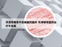 天津市哪家牛皮癣医院最好 天津哪家医院治疗牛皮癣