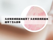 头皮银屑病屑越来越薄了 头皮银屑病屑越来越薄了怎么回事