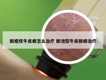 脓疱性牛皮癣怎么治疗 脓泡型牛皮肤癣治疗