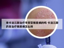 用卡泊三醇治疗寻常型银屑病的吗 卡泊三醇药膏治疗银屑病怎么样