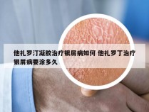 他扎罗汀凝胶治疗银屑病如何 他扎罗丁治疗银屑病要涂多久