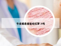 牛皮癣患者能吃红萝卜吗