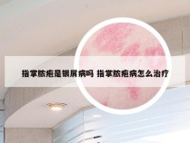 指掌脓疱是银屑病吗 指掌脓疱病怎么治疗